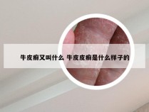 牛皮癣又叫什么 牛皮皮癣是什么样子的