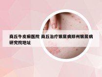 商丘牛皮癣医院 商丘治疗银屑病郑州银屑病研究院地址