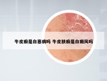 牛皮癣是白塞病吗 牛皮肤癣是白癜风吗