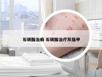 石碳酸治癣 石碳酸治疗灰指甲