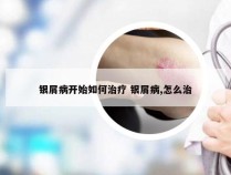 银屑病开始如何治疗 银屑病,怎么治