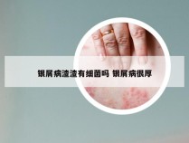 银屑病渣渣有细菌吗 银屑病很厚