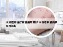 太原在哪治疗银屑病效果好 太原看银屑病的医院最好