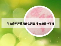 牛皮癣不严重用什么药膏 牛皮癣治疗不好