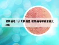 银屑病吃什么食物最佳 银屑病吃哪些东西比较好
