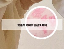普通牛皮癣会引起头疼吗