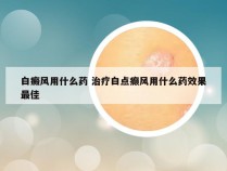 白癜风用什么药 治疗白点癫风用什么药效果最佳