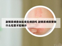 副银屑病查血能查出病因吗 副银屑病需要做什么检查才能确诊