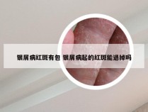 银屑病红斑有包 银屑病起的红斑能退掉吗