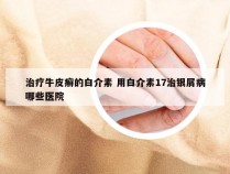 治疗牛皮癣的白介素 用白介素17治银屑病哪些医院