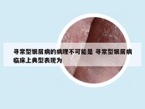 寻常型银屑病的病理不可能是 寻常型银屑病临床上典型表现为