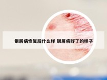 银屑病恢复后什么样 银屑病好了的样子