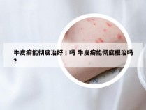 牛皮癣能彻底治好丨吗 牛皮癣能彻底根治吗?