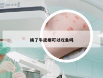 换了牛皮癣可以吃鱼吗
