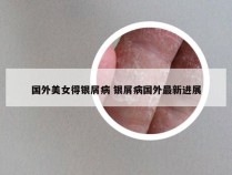国外美女得银屑病 银屑病国外最新进展