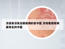 济南有没有治银屑病的老中医 济南看银屑病最有名的中医
