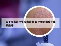 四平哪家治疗牛皮癣最好 四平哪家治疗牛皮癣最好