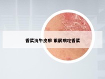 香菜洗牛皮癣 银屑病吃香菜