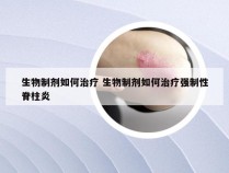 生物制剂如何治疗 生物制剂如何治疗强制性脊柱炎