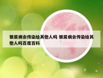 银屑病会传染给其他人吗 银屑病会传染给其他人吗百度百科