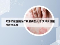 天津长征医院治疗银屑病怎么样 天津长征医院治什么病