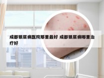 成都银屑病医院那里最好 成都银屑病哪里治疗好