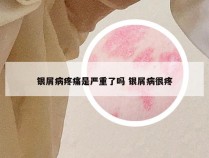 银屑病疼痛是严重了吗 银屑病很疼
