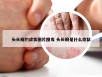 头长癣的症状图片图库 头长癣是什么症状