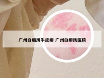 广州白癜风牛皮癣 广州白癣风医院