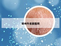 郑州牛皮藓医院