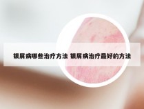 银屑病哪些治疗方法 银屑病治疗最好的方法