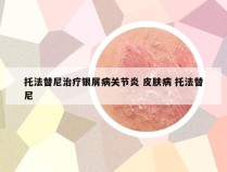 托法替尼治疗银屑病关节炎 皮肤病 托法替尼