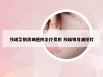 肢端型银屑病医院治疗费用 肢端银屑病图片