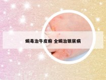 蝎毒治牛皮癣 全蝎治银屑病