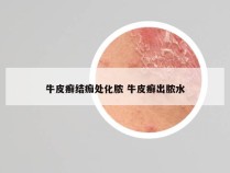 牛皮癣结痂处化脓 牛皮癣出脓水