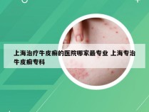上海治疗牛皮癣的医院哪家最专业 上海专治牛皮癣专科