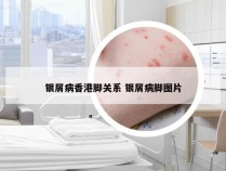 银屑病香港脚关系 银屑病脚图片
