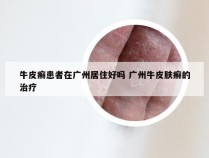 牛皮癣患者在广州居住好吗 广州牛皮肤癣的治疗