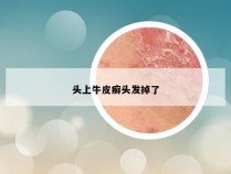 头上牛皮癣头发掉了