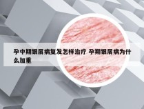孕中期银屑病复发怎样治疗 孕期银屑病为什么加重