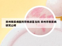郑州银屑病医院荐杨淑莲当找 郑州市银屑病研究口碑