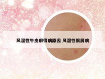 风湿性牛皮癣得病原因 风湿性银屑病