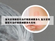 复方甘草酸苷片治疗银屑病要多久 复方甘草酸苷片治疗银屑病要多久见效