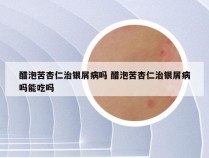 醋泡苦杏仁治银屑病吗 醋泡苦杏仁治银屑病吗能吃吗