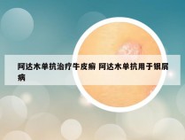 阿达木单抗治疗牛皮癣 阿达木单抗用于银屑病