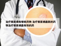 治疗银屑病有哪些药物 治疗银屑病最新的药物治疗银屑病最有效的药