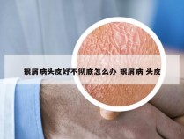 银屑病头皮好不彻底怎么办 银屑病 头皮
