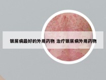 银屑病最好的外用药物 治疗银屑病外用药物