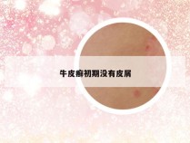 牛皮癣初期没有皮屑