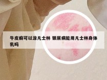 牛皮癣可以涂凡士林 银屑病能用凡士林身体乳吗
